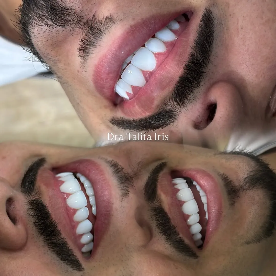 Antes e depois de lentes em resina