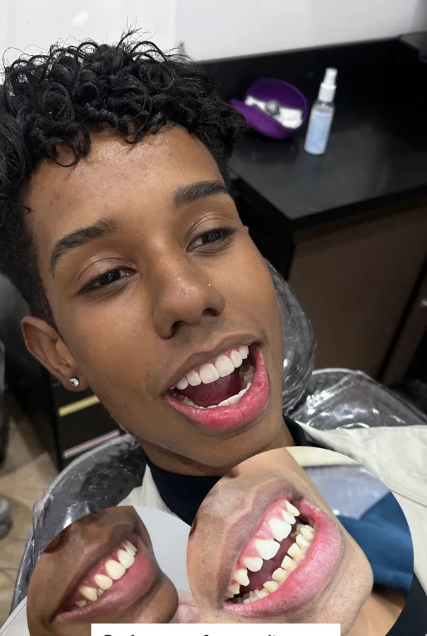Paciente sorrindo depois da gengivoplastia