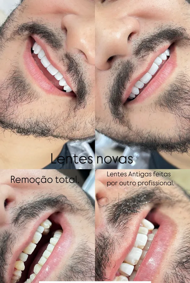Remoção de lentes antigas e lentes novas